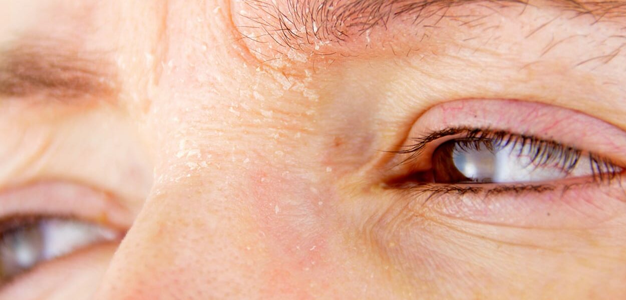 Vruchtbaar bemanning proza Droge huid in je gezicht: de oorzaken en dit doe je ertegen