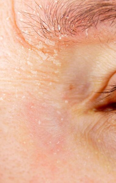 huid in je gezicht: oorzaken en dit doe je ertegen