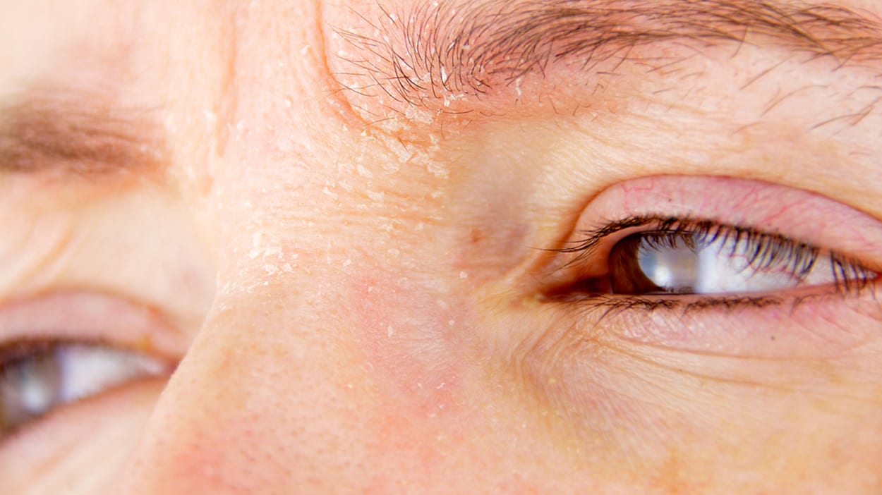 Vruchtbaar bemanning proza Droge huid in je gezicht: de oorzaken en dit doe je ertegen