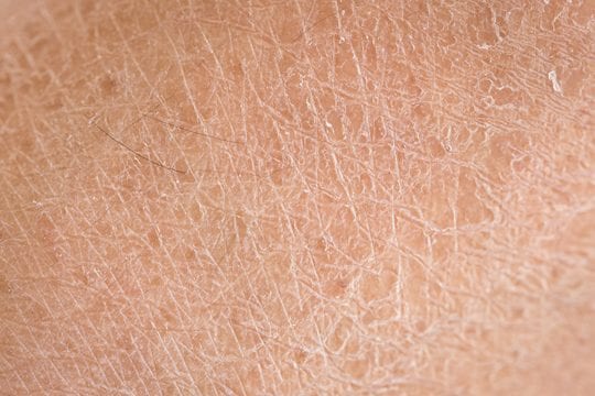 Grijp kolonie Oxideren Wat te doen bij een craquelé huid? | ALHYDRAN