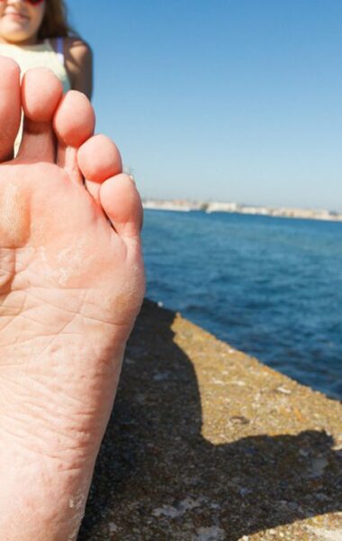 Wat helpt tegen droge voeten? en de oplossing!
